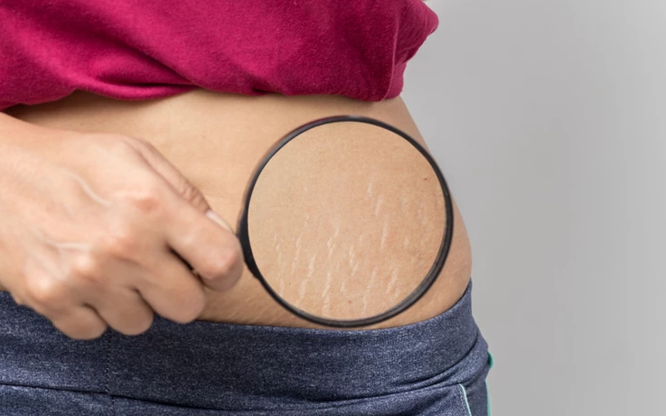 Stretch Marks: Common Causes and how to get rid of them