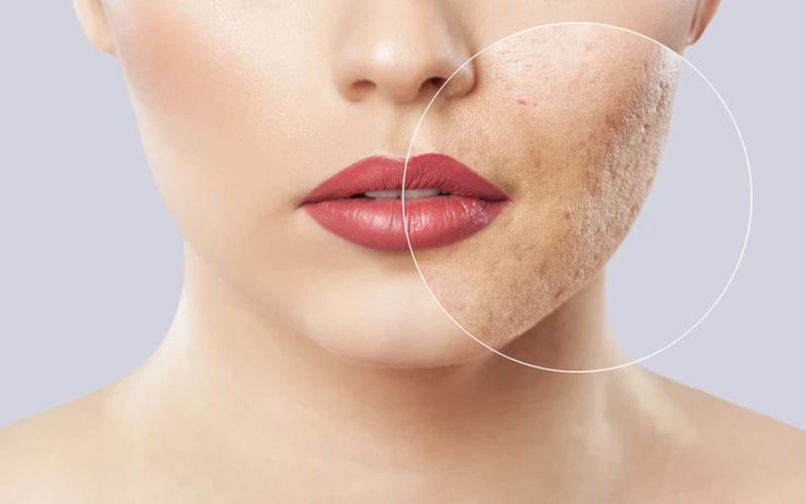 Tips by Dr Monica Chahar to prevent Acne Scars