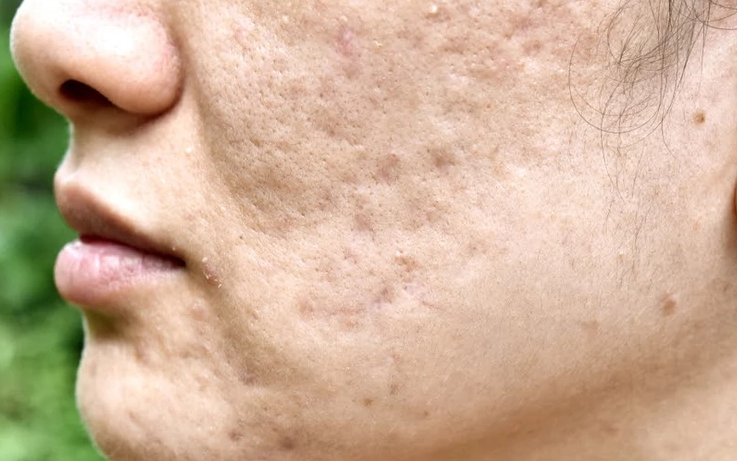 Dealing with ACNE SCARS- How we treat them to get CLEAR SKIN