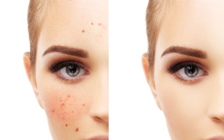 SKIN DECOR’s ACNE CLEAR Treatment