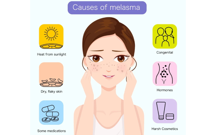 MELASMA: What lies beneath the mask?