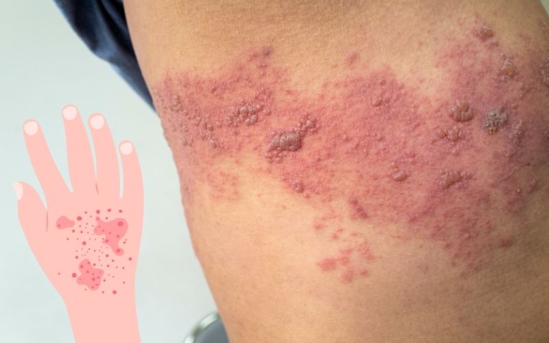 Skin Doctor Explains Shingles Rash Disease and its Treatment in Delhi 
