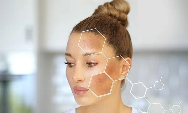 Beware of These Common Triggers of Melasma