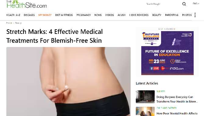 Stretch Marks: 4 Effective Medical