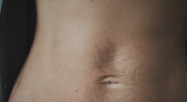 Stretch Marks and Scars