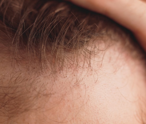 Best Hair Transplant in Dwarka