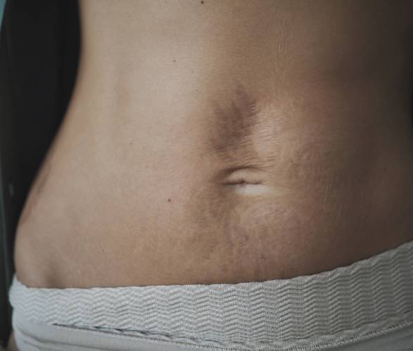 Stretch Marks Treatment in Dwarka