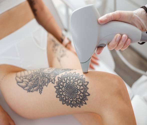 Tattoo Removal in Dwarka