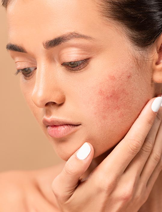 Best Acne Treatment Clinic in Dwarka