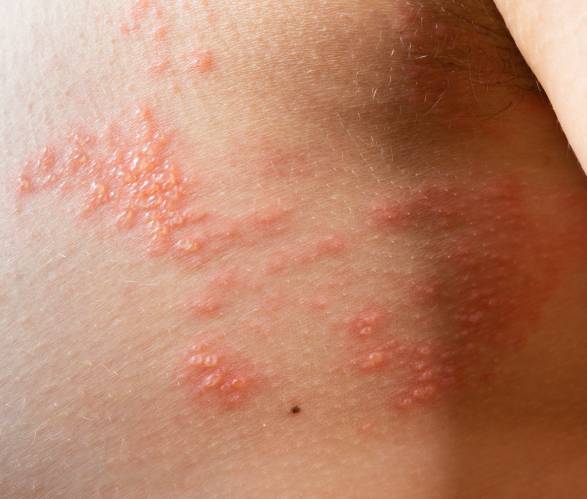 Urticaria Treatment in Dwarka